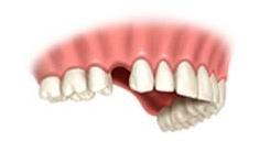 dental-implants-01